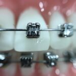 Ortodoncia en Las Rozas - Centro dental Heron